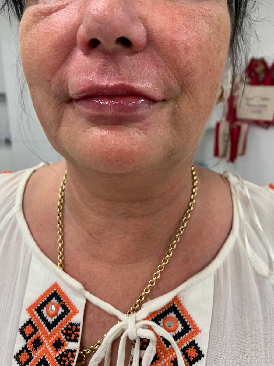 Lip filler result at The Luxe Clinic