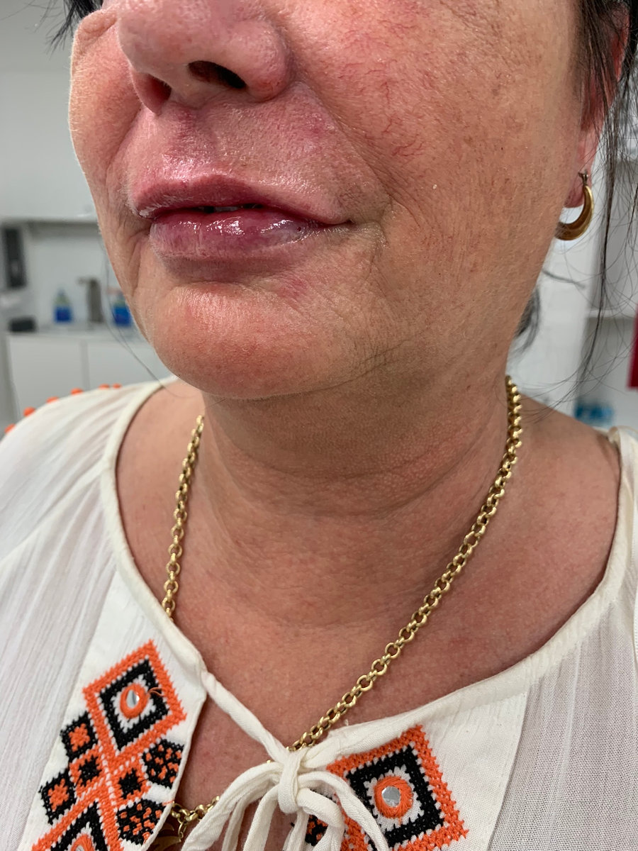 Dermal filler treatment at The Luxe Clinic