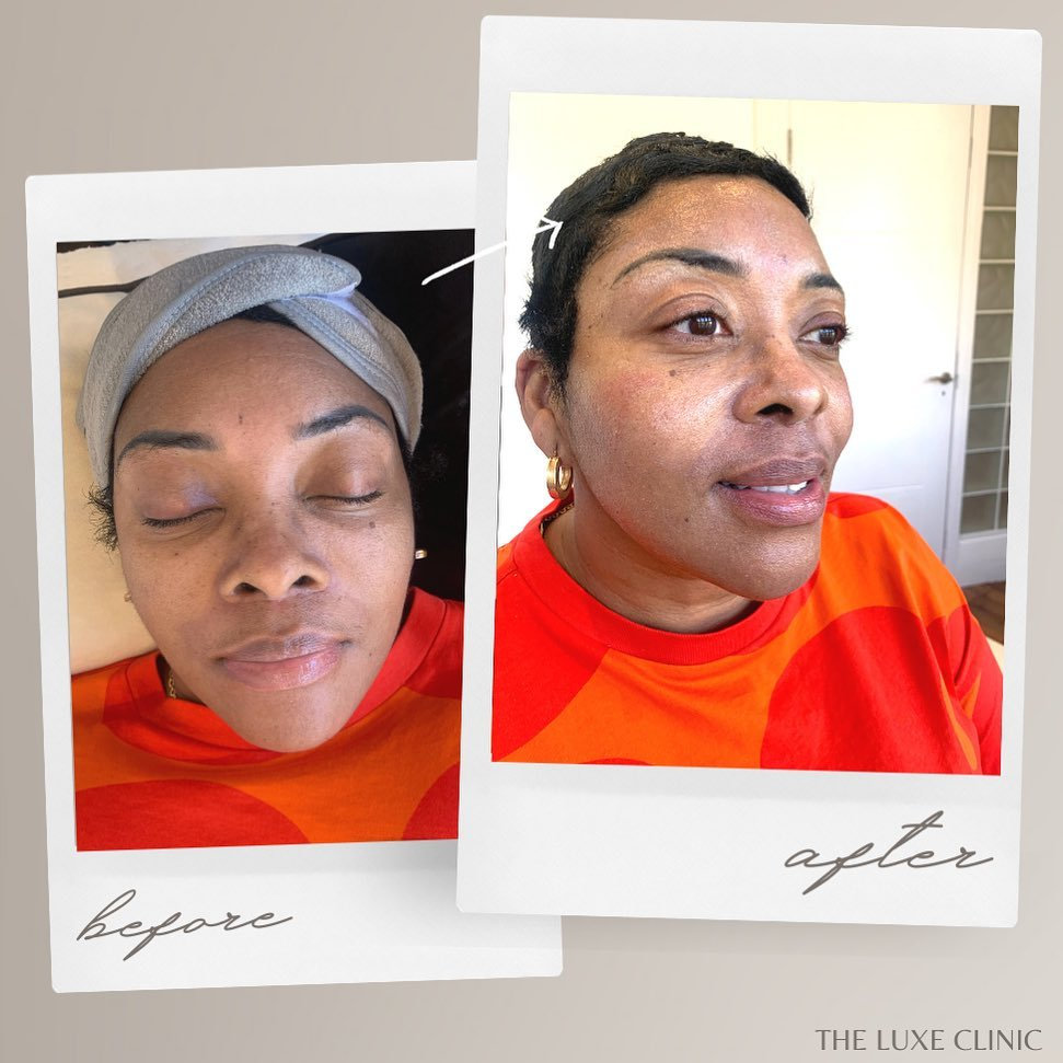 Microneedling treatment